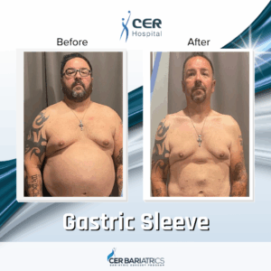 Gastric Sleeve