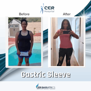 Gastric Sleeve