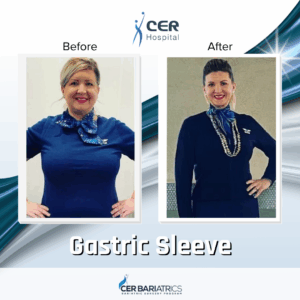Gastric Sleeve