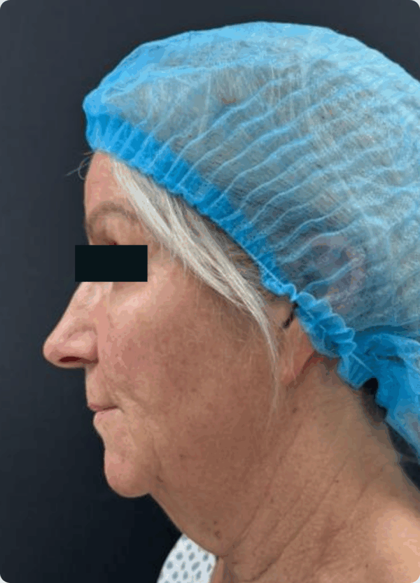 Lower Face Lift - 033 - Image 3
