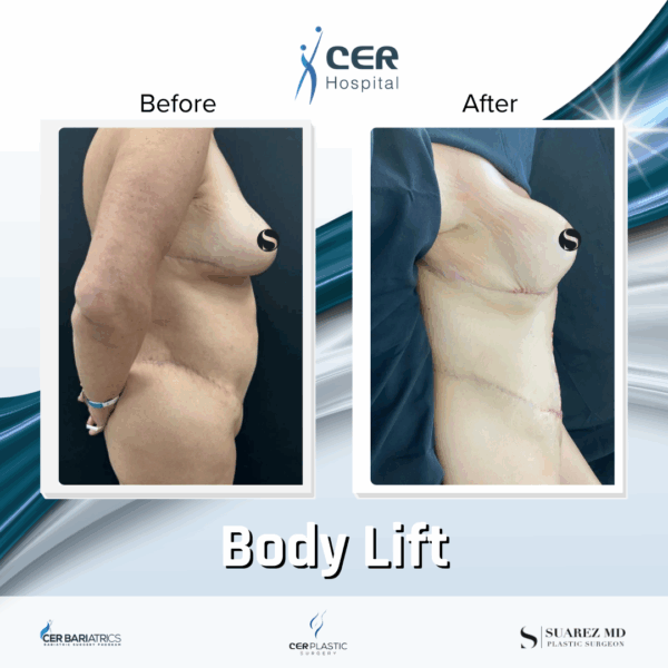 Body Lift - 243 - Image 7