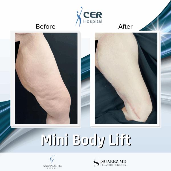 Body Lift - 094 - Image 7