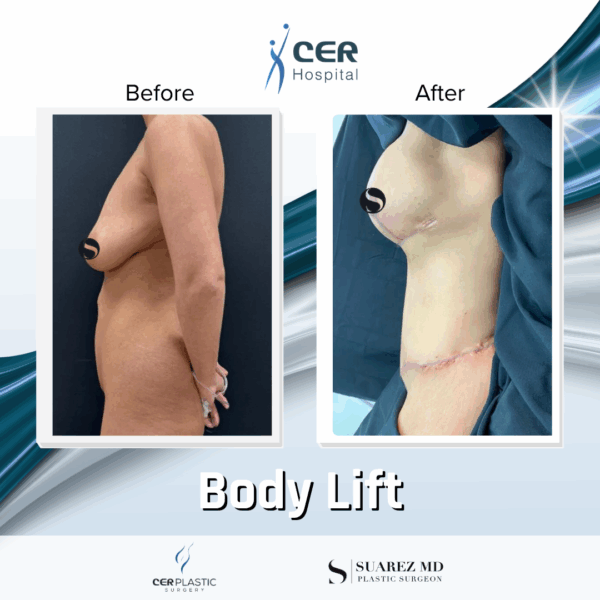 Body Lift - 125 - Image 8
