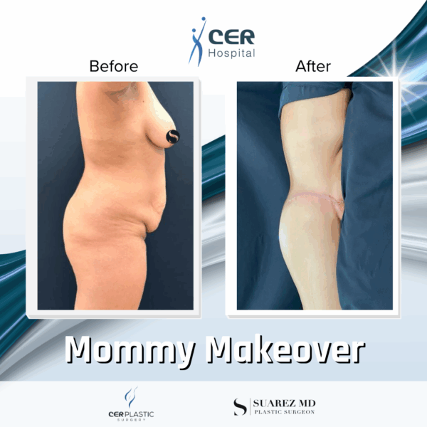 Mommy Makeover - 061 - Image 7