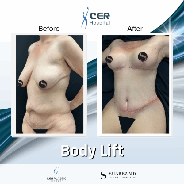 Body Lift - 165 - Image 8