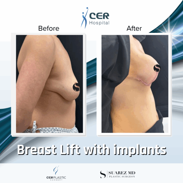 Breast Lift with Implants - 263 - Image 7