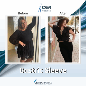 Gastric Sleeve