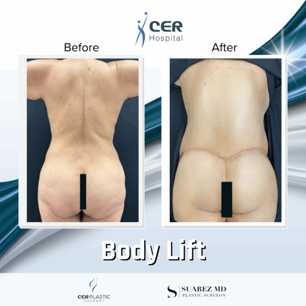 Body Lift - 213 - Image 7