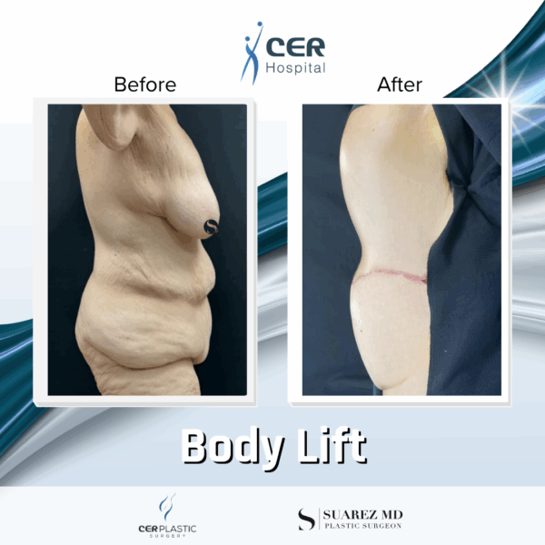 Body Lift - 075 - Image 8
