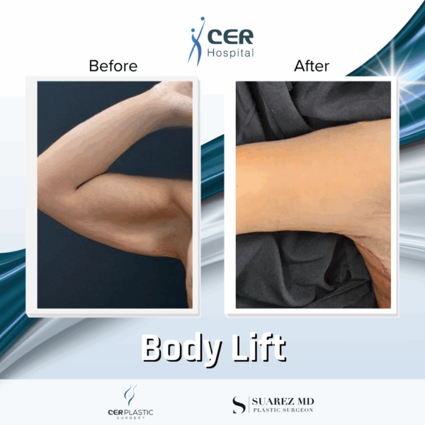 Body Lift - 304 - Image 7