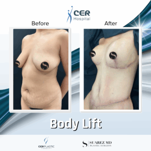 Body Lift – 234