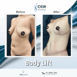 Body Lift – 234
