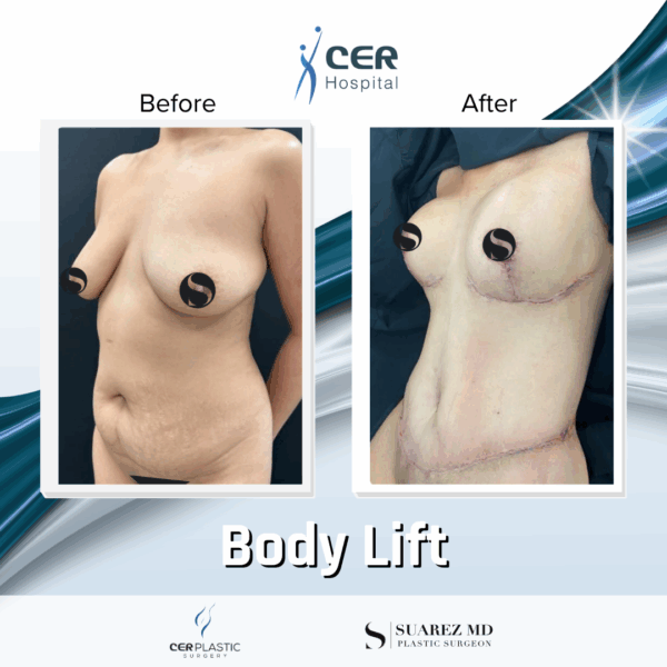 Body Lift - 234