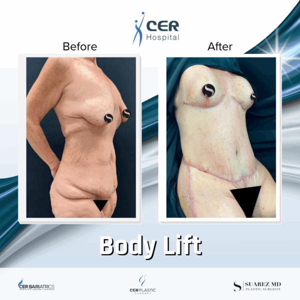 Body Lift - 291 - Image 8