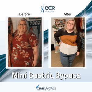 Mini Gastric Bypass