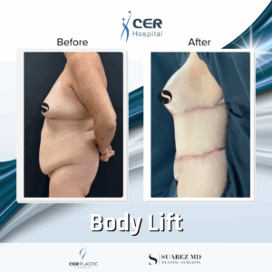 Body Lift – 037