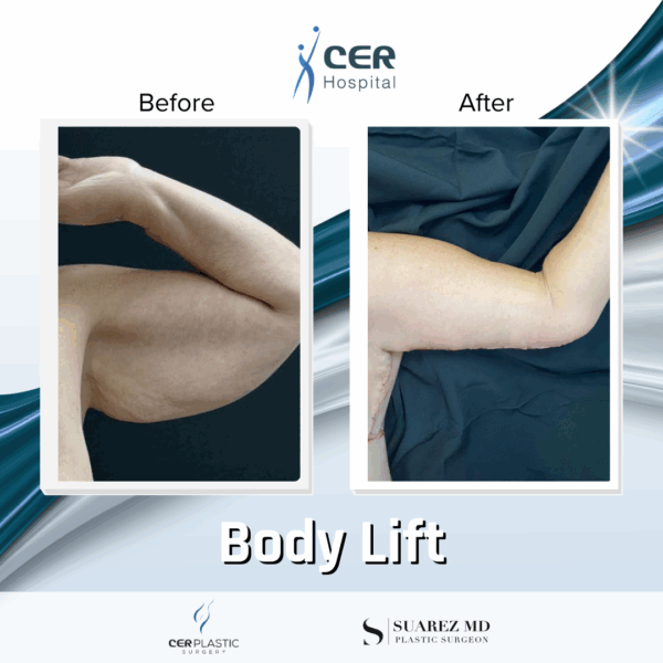 Body Lift -2094