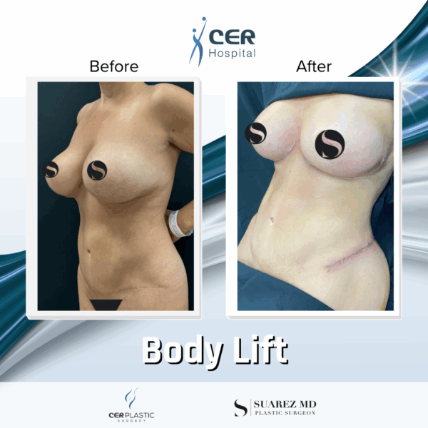 Body Lift -7104 - Image 8