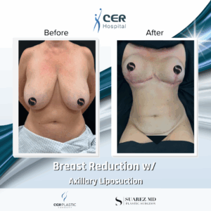 Breast Reduction and Axillary Liposuction – 042