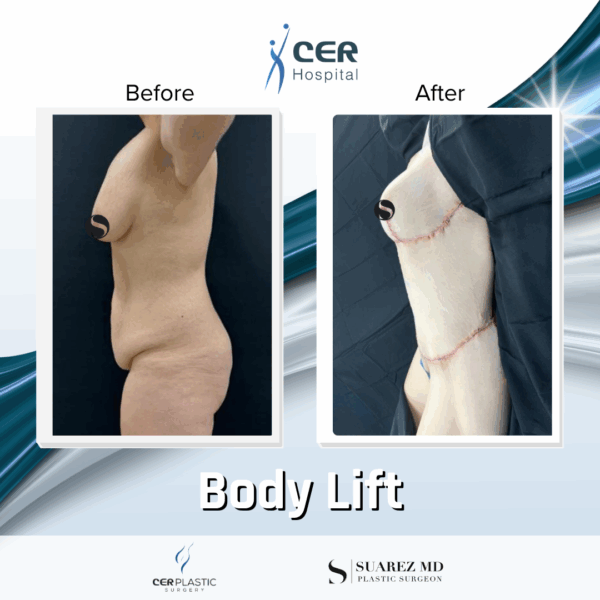 Body Lift - 26064