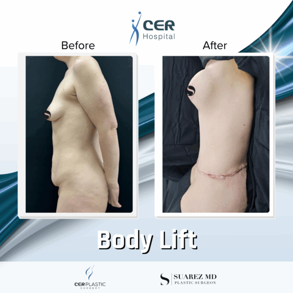 Body Lift - 19064 - Image 7