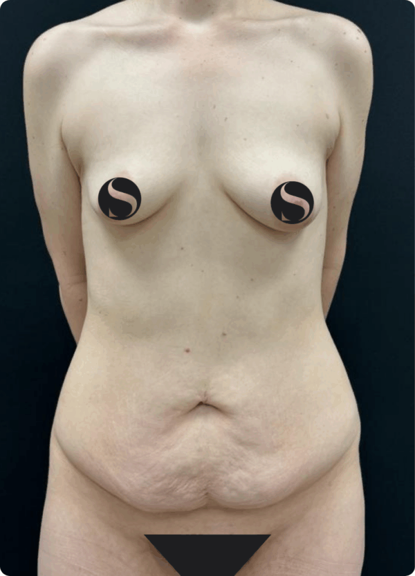 Body Lift - 19064 - Image 3