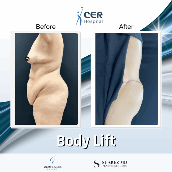 Body Lift - 17064 - Image 7