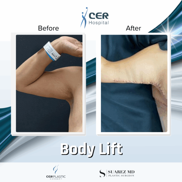Body Lift -14064 - Image 7