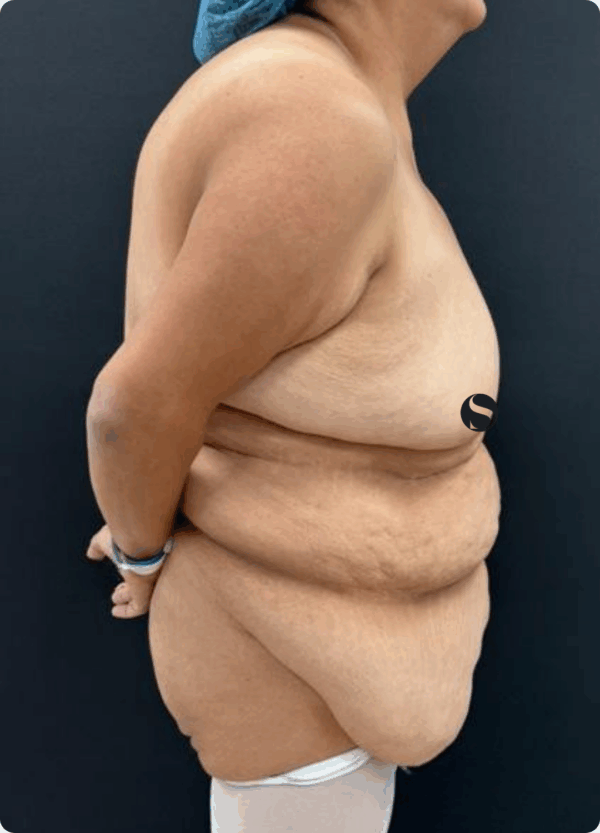 Body Lift -14064 - Image 3