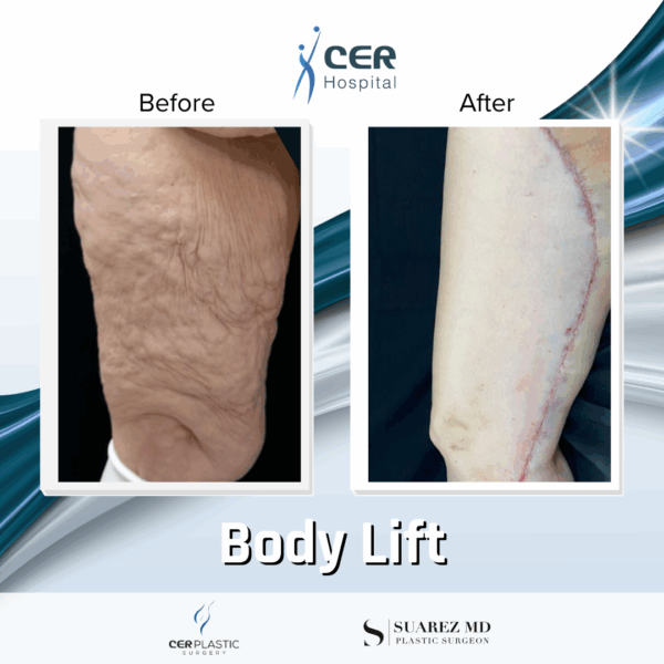 Mini Body Lift - 12064 - Image 7