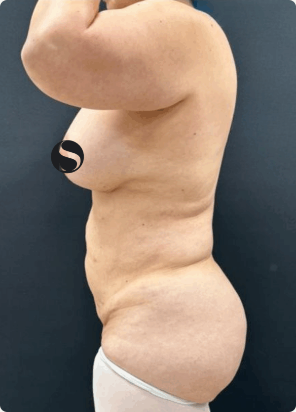 Body Lift and Eyelid Surgery - 5064 - Image 3
