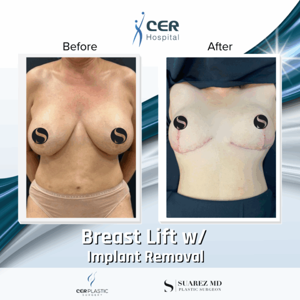 Breast Lift with Implant Removal - 5064 - Image 8