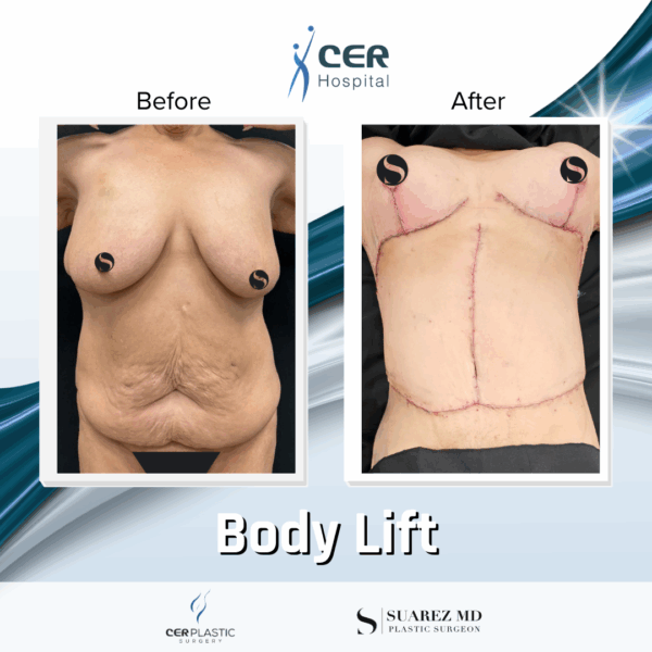 Body Lift - 20054 - Image 8