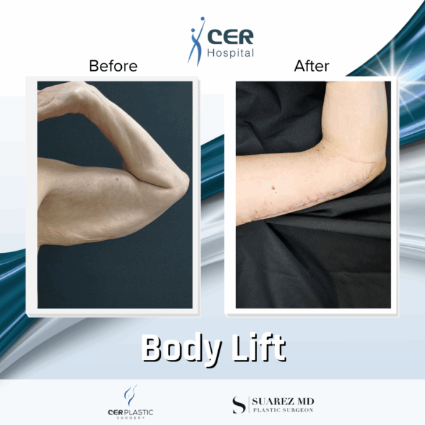 Body Lift - 17054 - Image 7