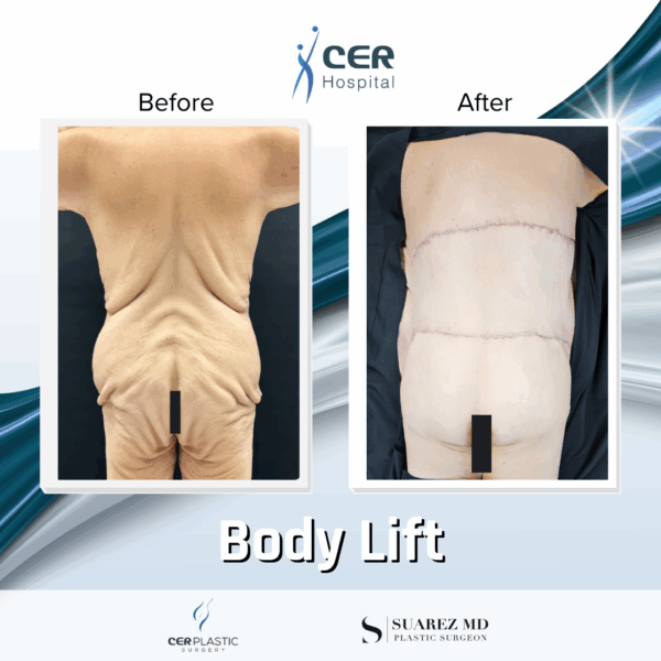 Body Lift - 8054 - Image 8