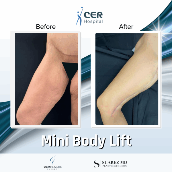 Mini Body Lift - 073 - Image 7