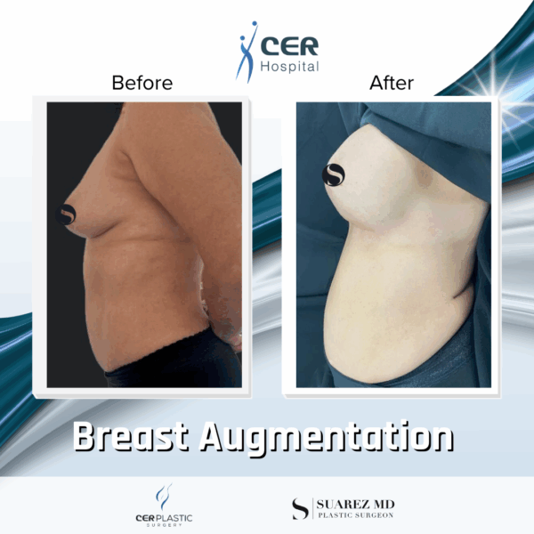 Breast Augmentation - 103 - Image 7