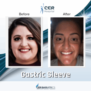 Gastric Sleeve