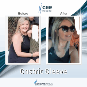 Gastric Sleeve