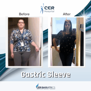 Gastric Sleeve