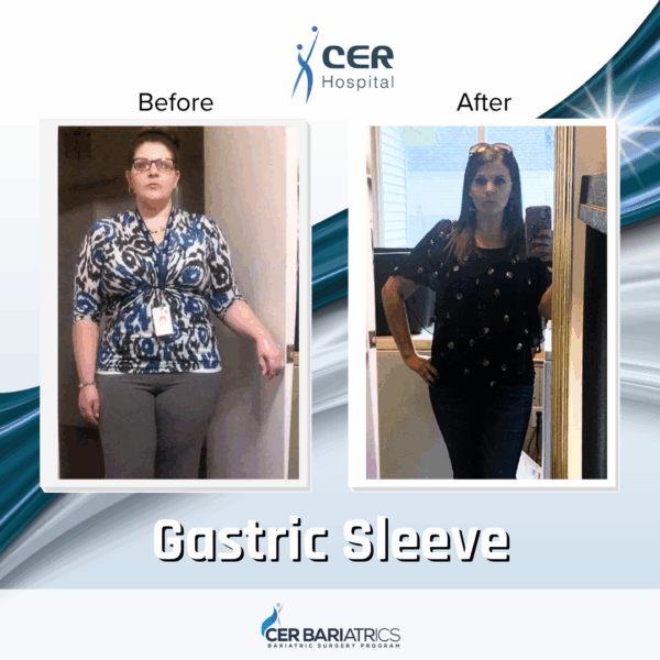 Gastric Sleeve