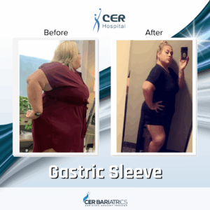 Gastric Sleeve