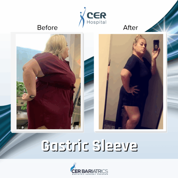 Gastric Sleeve