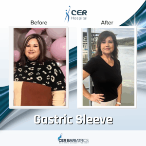 Gastric Sleeve