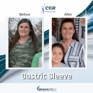 Gastric Sleeve