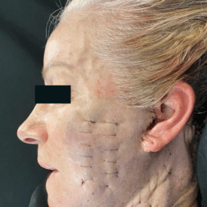 Lower Face Lift – 033