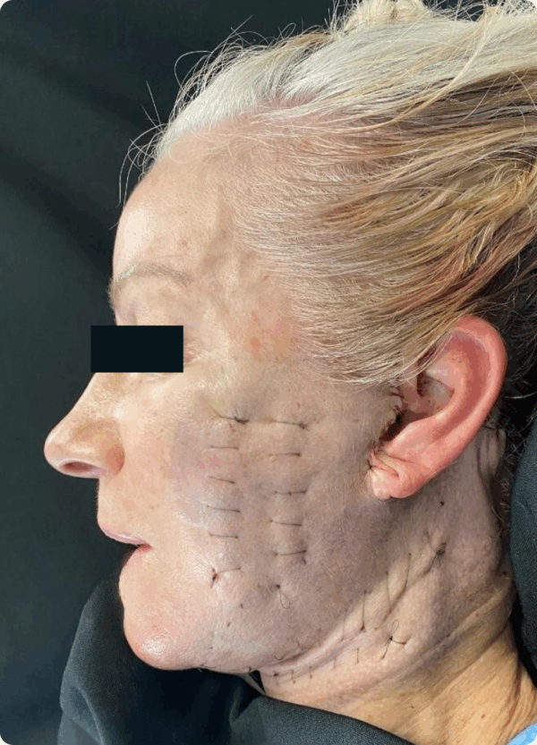 Lower Face Lift - 033 - Image 2