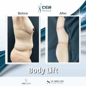 Body Lift – 165