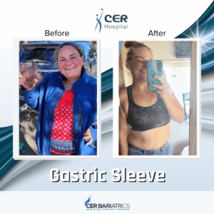 Gastric Sleeve