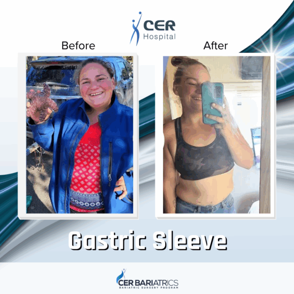 Gastric Sleeve